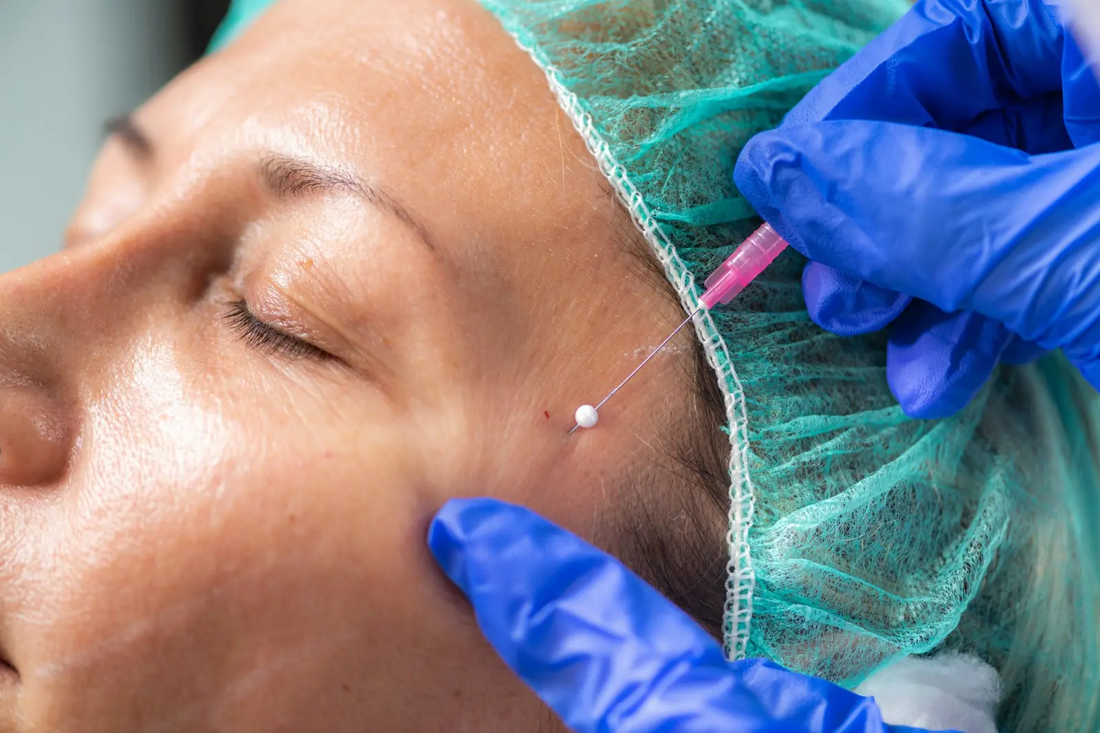 A thread lift being performed in a treatment room